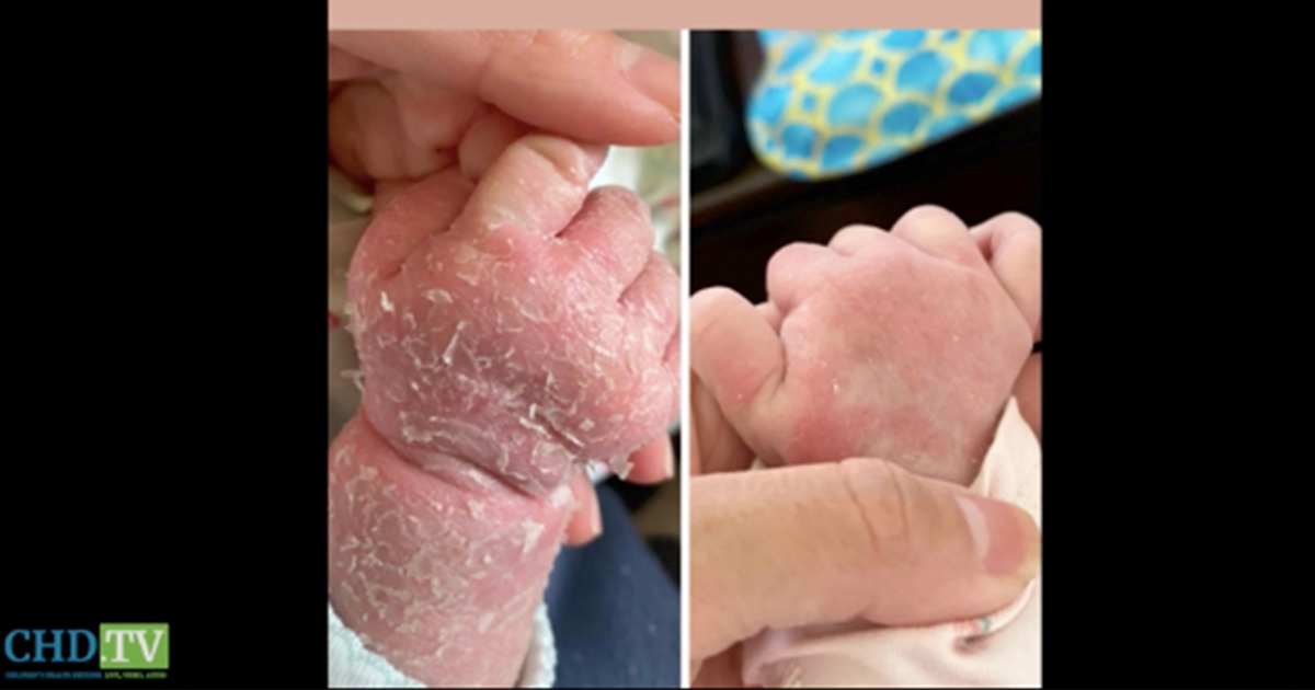 Topical Steroid Withdrawal — Hero Moms Speak Out