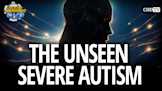 The Unseen Severe Autism