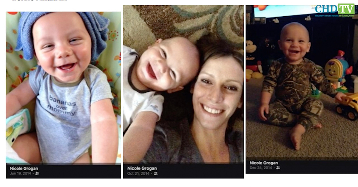 Polyethylene Glycol 3350 Results in Child’s Seizures + Allergies