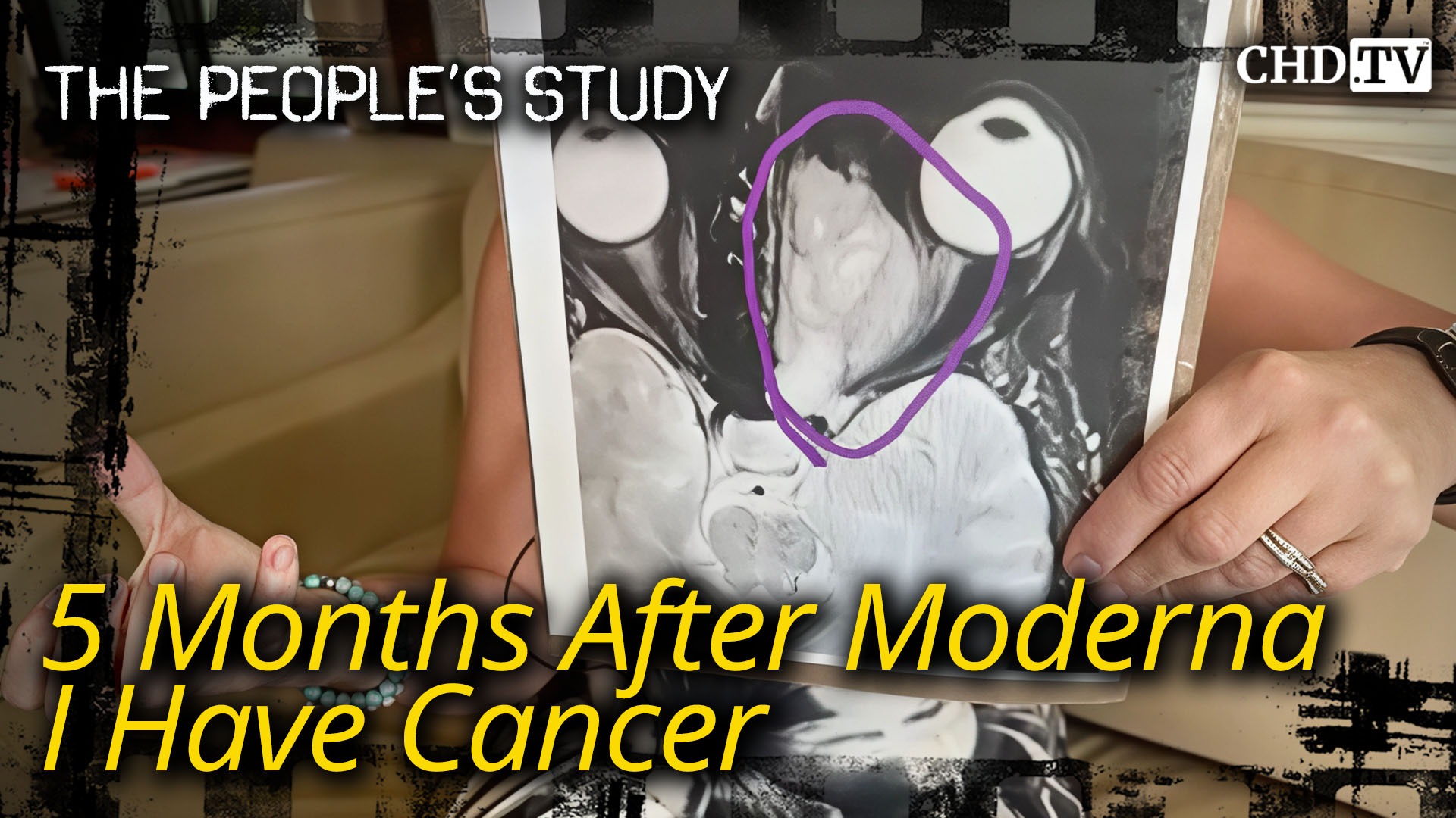 5 Months After Moderna I Have Cancer