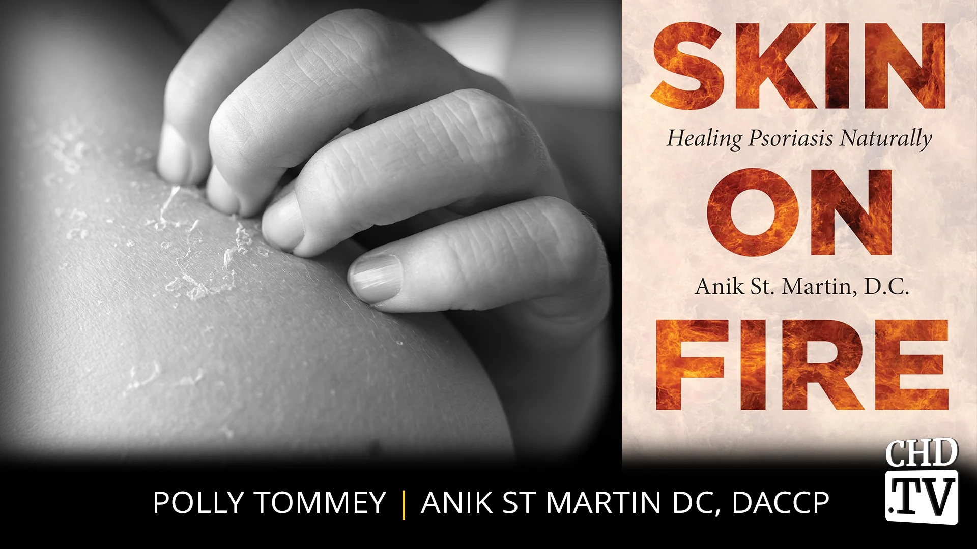 Skin on Fire: Healing Psoriasis Naturally