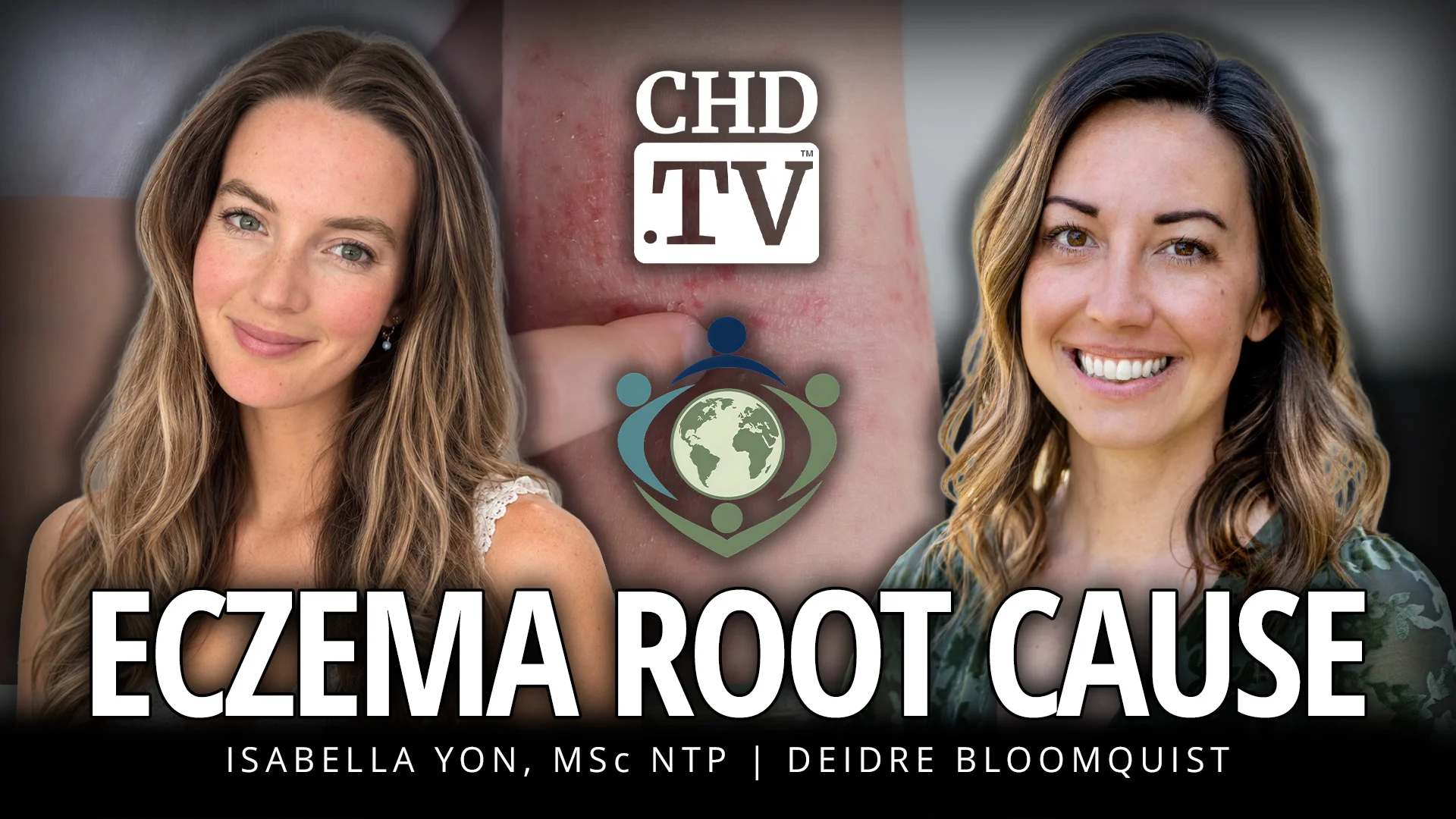 Eczema Root Cause