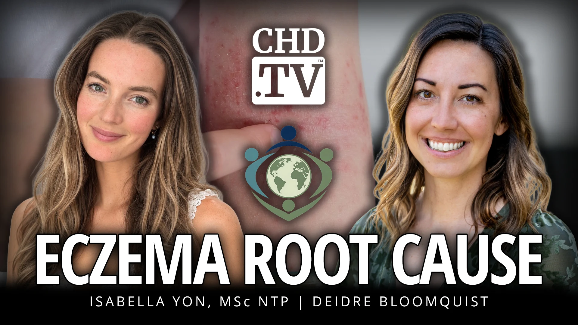 Eczema Root Cause